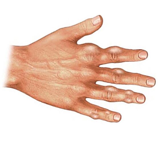 Ablagerung von Harnsäurekristallen in den Weichteilen der Finger bei Gichtarthritis