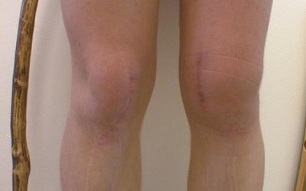 Entwicklungsstadien der Knie-Arthrose