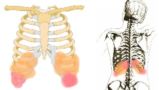 Rückenschmerzen unter den rippen Symptome