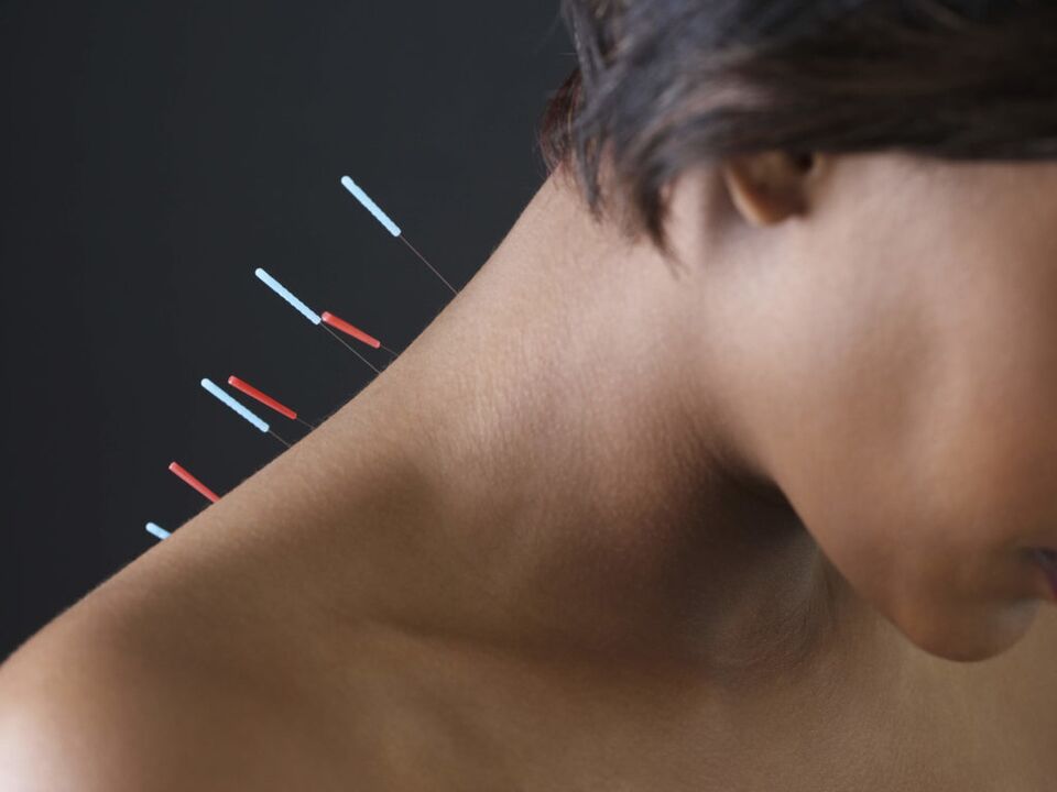 Akupunktur bei zervikaler Osteochondrose beseitigt entzündliche Prozesse. 