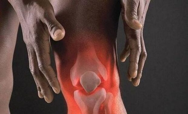 Arthrose wird von einem Entzündungsprozess im Kniegelenk begleitet. 
